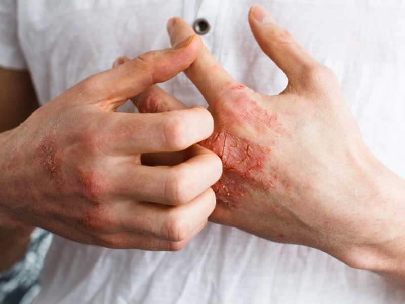 Bệnh chàm có nguyên nhân gì khiến da bị viêm gây kích ứng?
